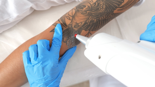 Tattoo Removers – What Could Be The Safest Tattoo Removal Choosing?