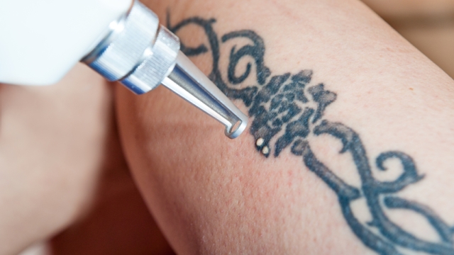 4 Most Commonplace Motives Why People May Wish To Undergo Tattoo Laser Removal