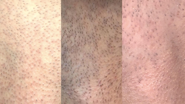 Unlock Smoothness: The Ultimate Guide to Laser Hair Removal